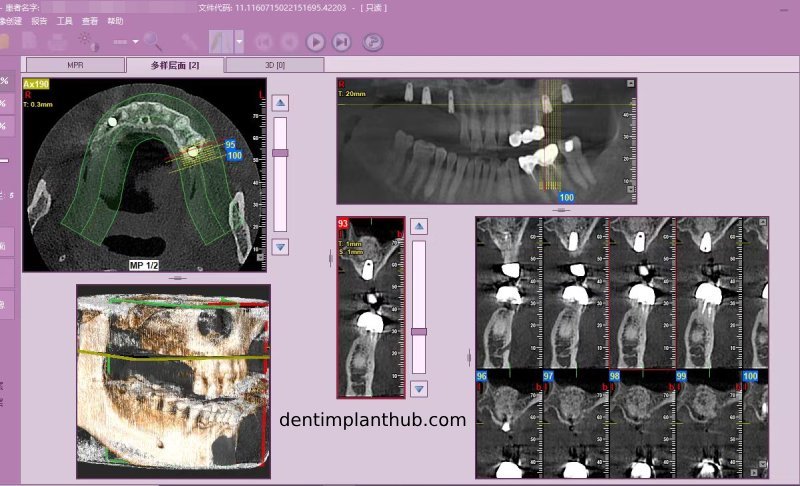 Case 4: Bilateral maxillary sinus lateral wall openings