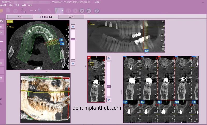 Case 4: Bilateral maxillary sinus lateral wall openings