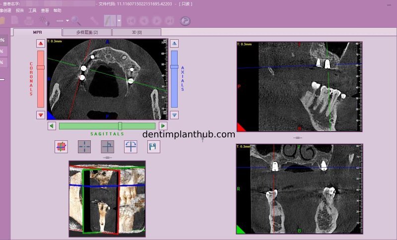 Case 4: Bilateral maxillary sinus lateral wall openings