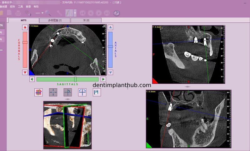 Case 4: Bilateral maxillary sinus lateral wall openings