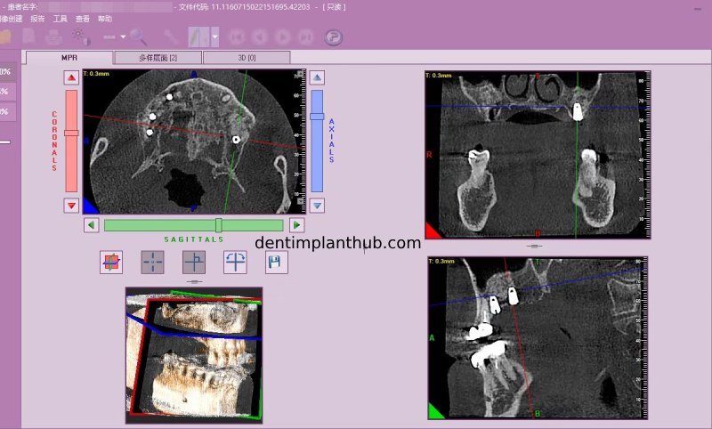 Case 4: Bilateral maxillary sinus lateral wall openings