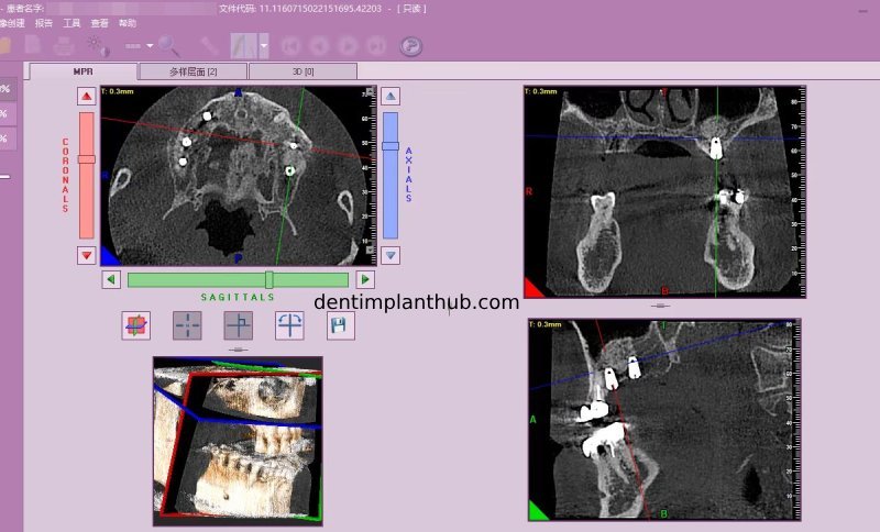 Case 4: Bilateral maxillary sinus lateral wall openings