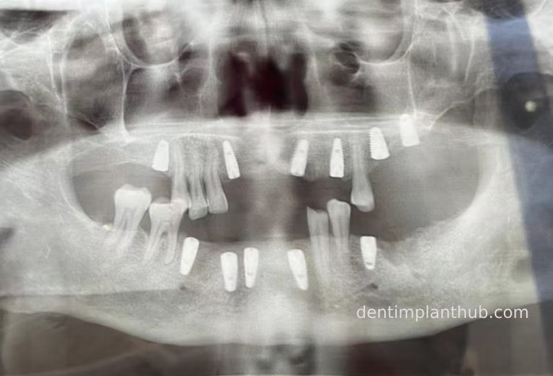 Case 5: 11 implants in one surgical implant procedure