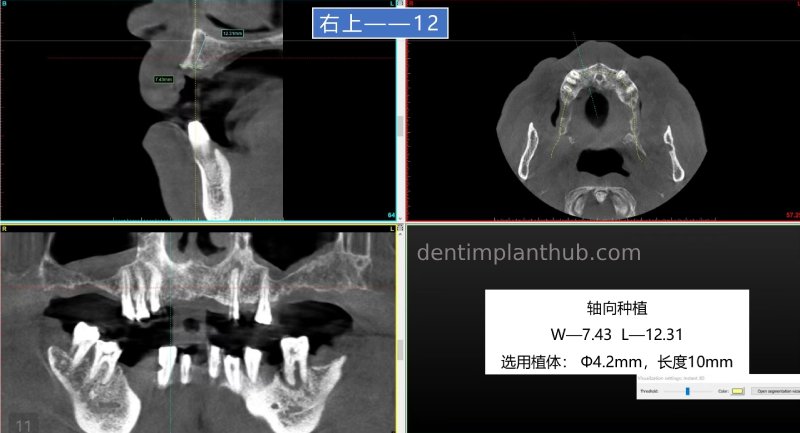 Case 5: 11 implants in one surgical implant procedure