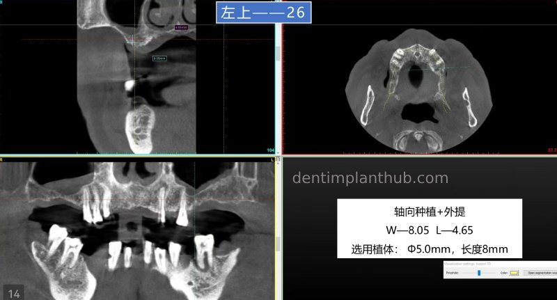 Case 5: 11 implants in one surgical implant procedure