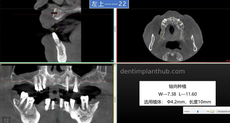 Case 5: 11 implants in one surgical implant procedure