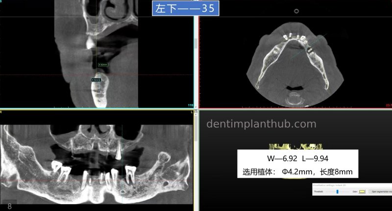 Case 5: 11 implants in one surgical implant procedure