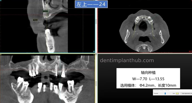 Case 5: 11 implants in one surgical implant procedure