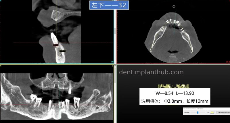 Case 5: 11 implants in one surgical implant procedure