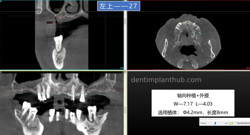 Case 5: 11 implants in one surgical implant procedure