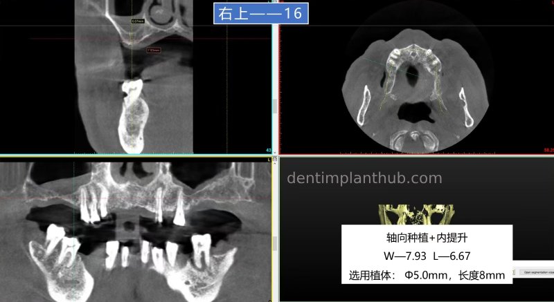 Case 5: 11 implants in one surgical implant procedure