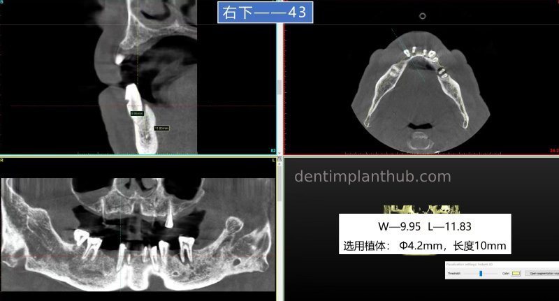 Case 5: 11 implants in one surgical implant procedure