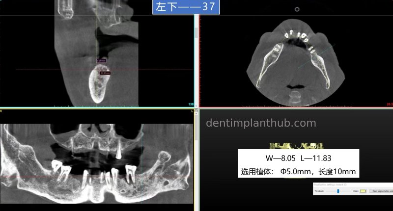Case 5: 11 implants in one surgical implant procedure
