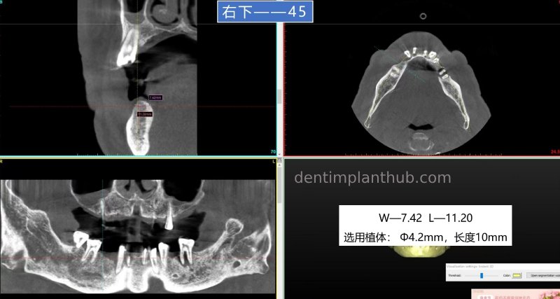 Case 5: 11 implants in one surgical implant procedure