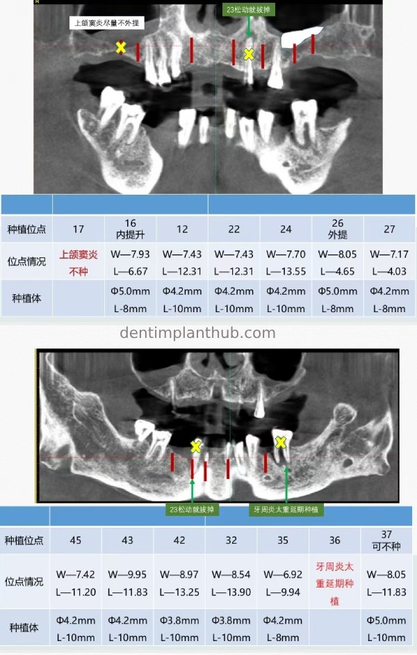 Case 5: 11 implants in one surgical implant procedure
