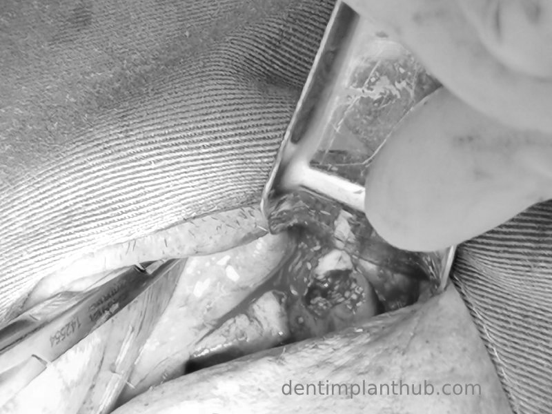 Case 5: 11 implants in one surgical implant procedure